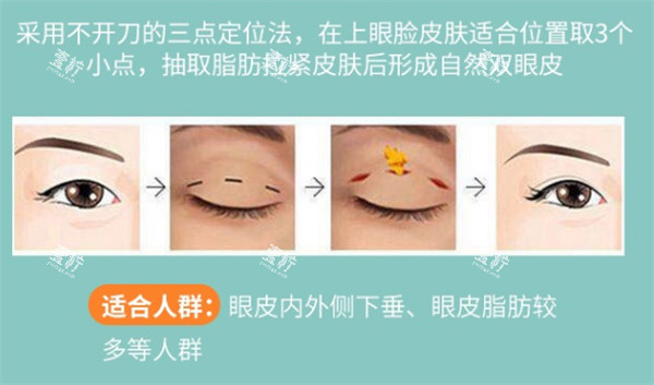 三点双眼皮解析.jpg 三点双眼皮解析.jpg