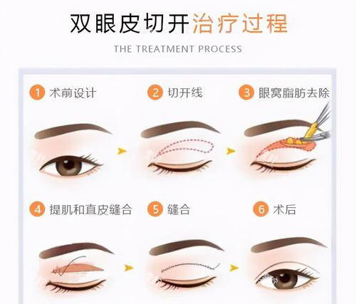 双眼皮手术方法过程图.jpg 双眼皮手术方法过程图.jpg