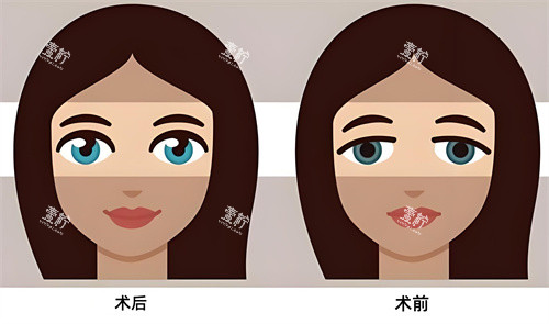 双眼皮术后术前对比动画图.jpg 双眼皮术后术前对比动画图.jpg