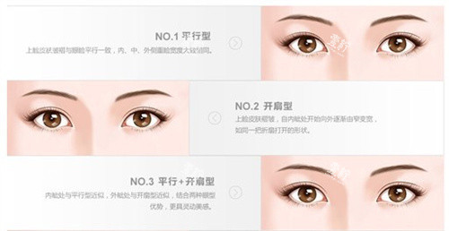 双眼皮的类型.jpg 双眼皮的类型.jpg