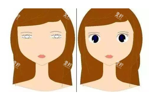 眼皮松弛做双眼皮对比图.jpg 眼皮松弛做双眼皮对比图.jpg