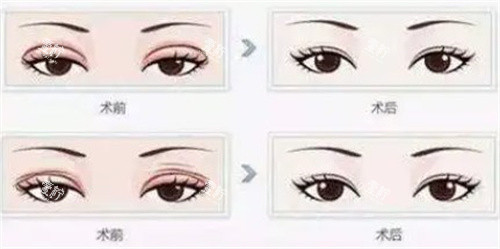 双眼皮修复.jpg 双眼皮修复.jpg