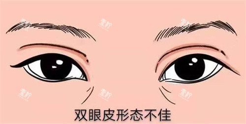 修复双眼皮.jpg 修复双眼皮.jpg