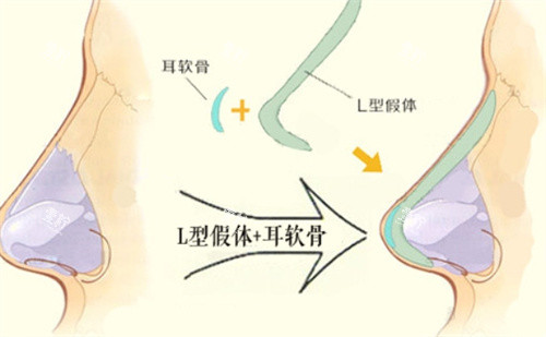 L形隆鼻假体.jpg L形隆鼻假体.jpg