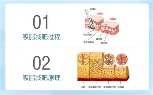 吸脂减肥过程及原理.jpg 吸脂减肥过程及原理.jpg
