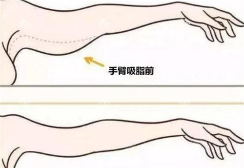 手臂吸脂.jpg 手臂吸脂.jpg