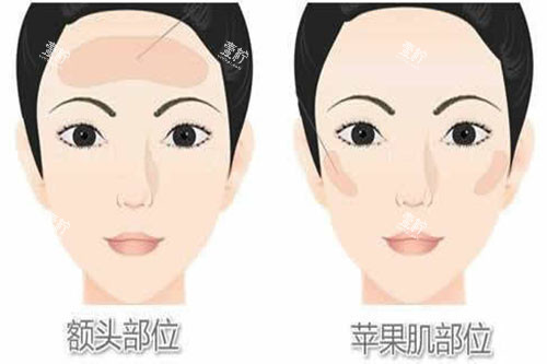 脂肪填充部位展示图.jpg 脂肪填充部位展示图.jpg