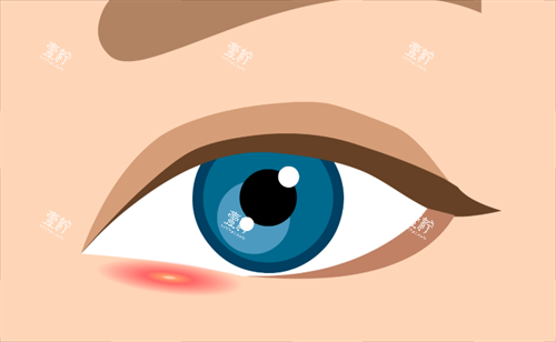 双眼皮疤痕.png 双眼皮疤痕.png