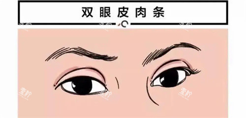 双眼皮肉条痕图.jpg 双眼皮肉条痕图.jpg