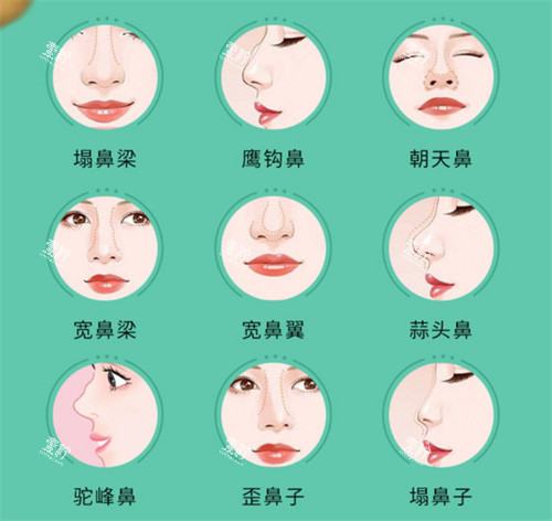 鼻部整形手术适应症.jpg 鼻部整形手术适应症.jpg