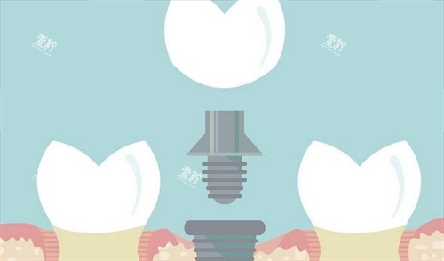 组成种植牙的三部分动画展示.png 组成种植牙的三部分动画展示.png