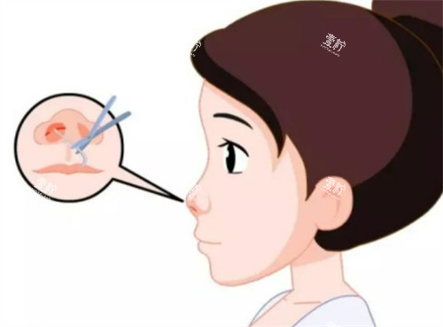隆鼻切口的位置图解.jpg 隆鼻切口的位置图解.jpg