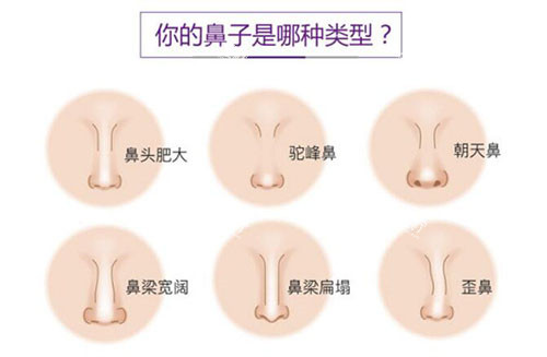 需要隆鼻常见鼻型.jpg 需要隆鼻常见鼻型.jpg