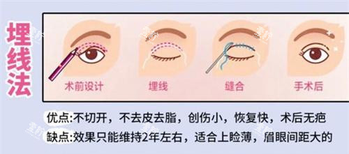双眼皮手术埋线法动画演示图.jpg 双眼皮手术埋线法动画演示图.jpg