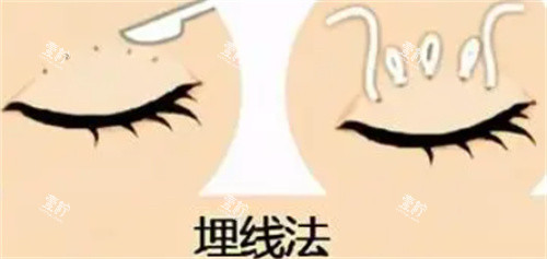 双眼皮埋线怎么做的.jpg 双眼皮埋线怎么做的.jpg