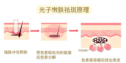 光子嫩肤的祛斑原理.jpg 光子嫩肤的祛斑原理.jpg