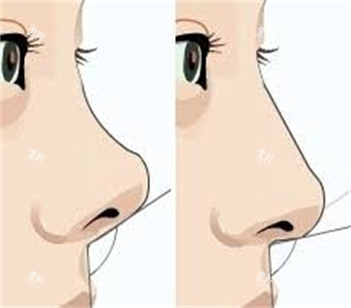 隆鼻手术膨体隆鼻前后对比.jpg