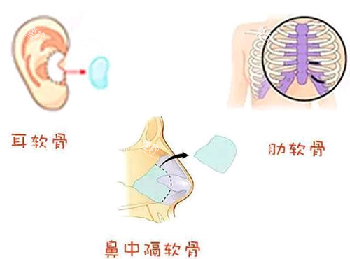 隆鼻手术.png