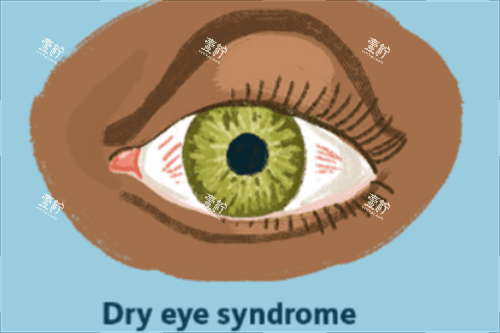 干眼综合征.png 干眼综合征.png