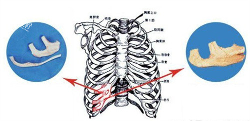 耳再造手术自体肋软骨.jpg 耳再造手术自体肋软骨.jpg