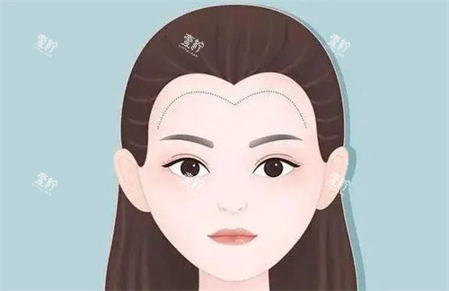 植发际线卡通.jpg
