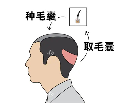毛发移植卡通图片.jpg
