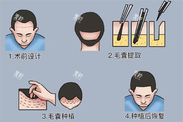 植发手术.jpg 植发手术.jpg