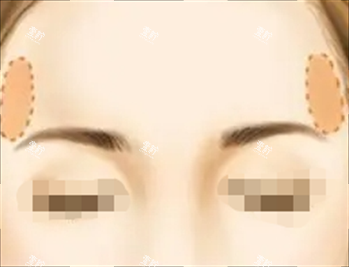面部脂肪填充丰太阳穴动画展示图.png 面部脂肪填充丰太阳穴动画展示图.png