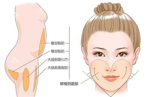 面部脂肪填充卡通图.jpg 面部脂肪填充卡通图.jpg