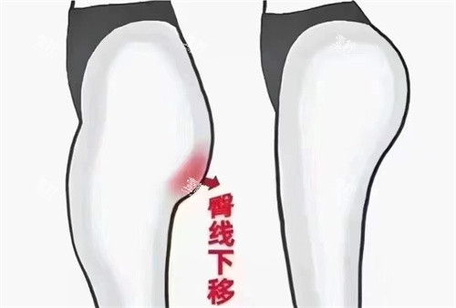 臀部脂肪填充对比.jpg 臀部脂肪填充对比.jpg