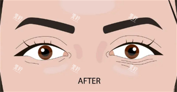 双眼皮手术后.jpg