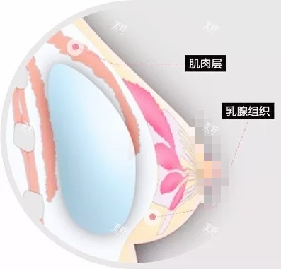 双平面丰胸.jpg