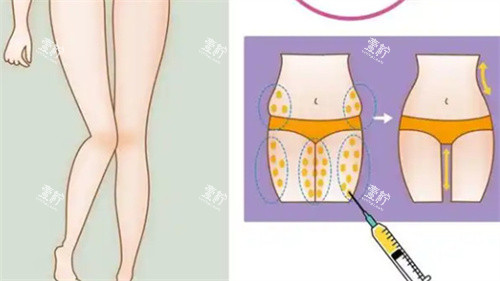 大腿吸脂手术.jpg