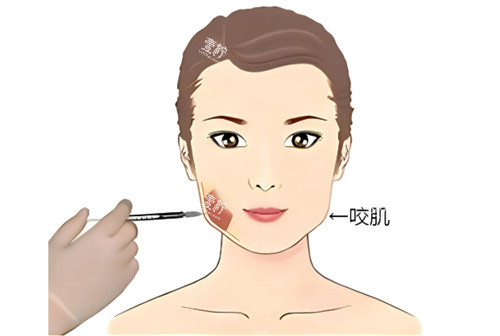 打针瘦脸.jpg