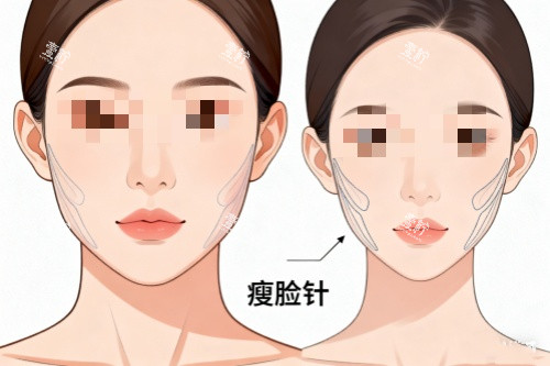 针剂注射瘦脸对比图.jpg