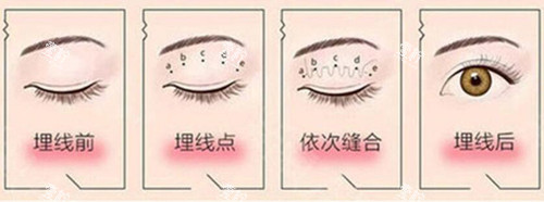 埋线双眼皮过程示意图片.jpg