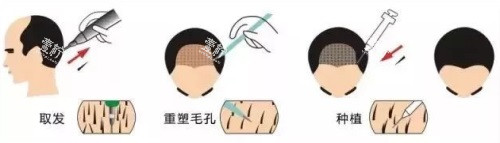 植发过程图.JPG