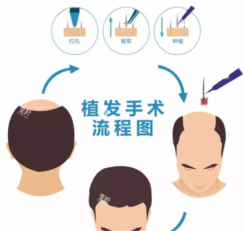 植发手术流程图解.jpg