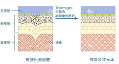 热玛吉作用在皮肤上皮下组织展示.png 热玛吉作用在皮肤上皮下组织展示.png