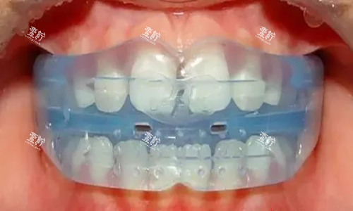 MRC儿童牙齿早期干预矫治器.jpg MRC儿童牙齿早期干预矫治器.jpg