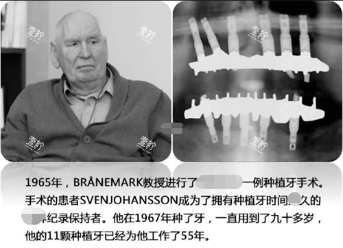 种植牙记录示意图.jpg 种植牙记录示意图.jpg