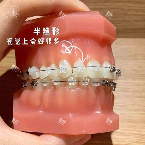 牙齿矫正陶瓷自锁托槽模型.jpg