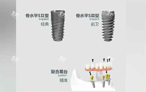 安联种植牙用起来怎么样.png 安联种植牙用起来怎么样.png