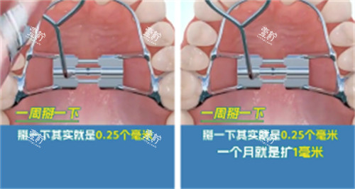 Hyrax扩弓器矫正方法.jpg Hyrax扩弓器矫正方法.jpg