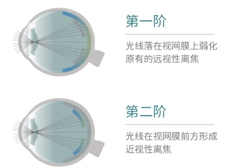 思问子夏离焦眼镜矫正过程.jpg 思问子夏离焦眼镜矫正过程.jpg