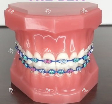 牙齿矫正牙套模型示意图.jpg