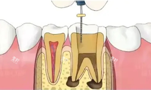 根管治疗中.jpg