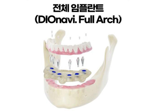 韩国dio种植体半口种植牙.jpg