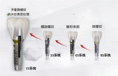 韩国奥齿泰种植体型号.jpg