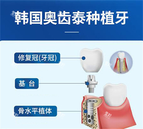 奥齿泰种植体材料图.jpg